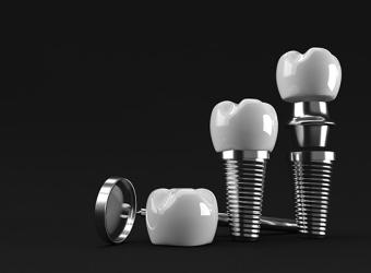 Understanding the Essentials of Implant Dentistry: A Guide to Dental Implants