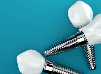 Understanding the Tooth Replacement Timeline with an Implant Dentist