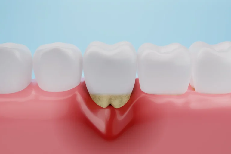 Illustration of receding gums and tartar build-up along the gum line