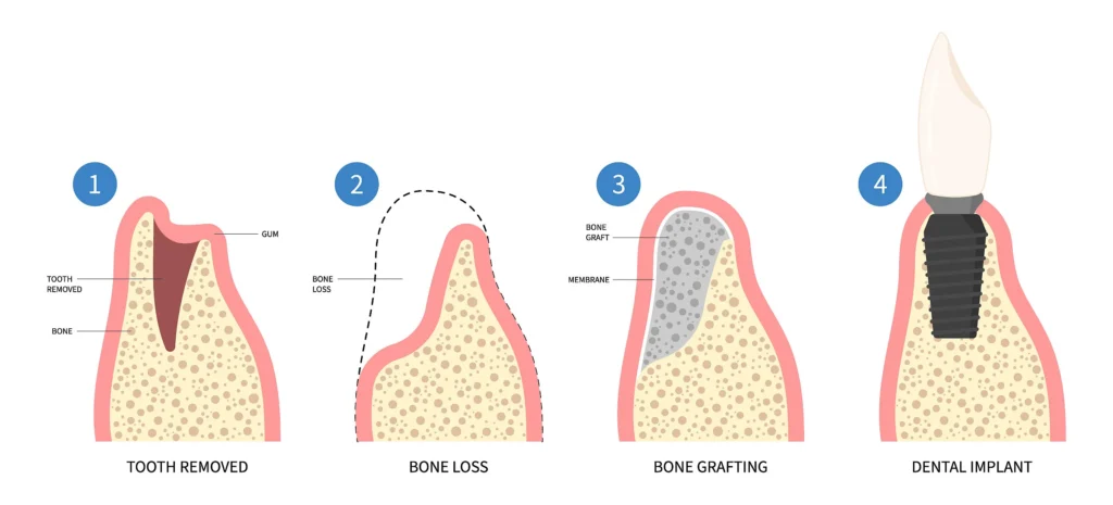 Four-stage diagram showing tooth removal, bone loss, bone grafting and implant placement