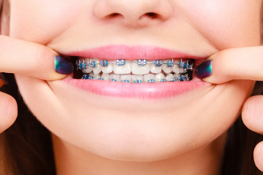 Close-up of a young person's teeth fitted with blue metal braces