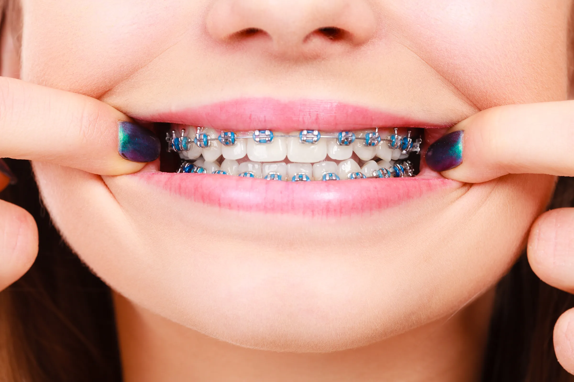 Close-up of a young person's teeth fitted with blue metal braces