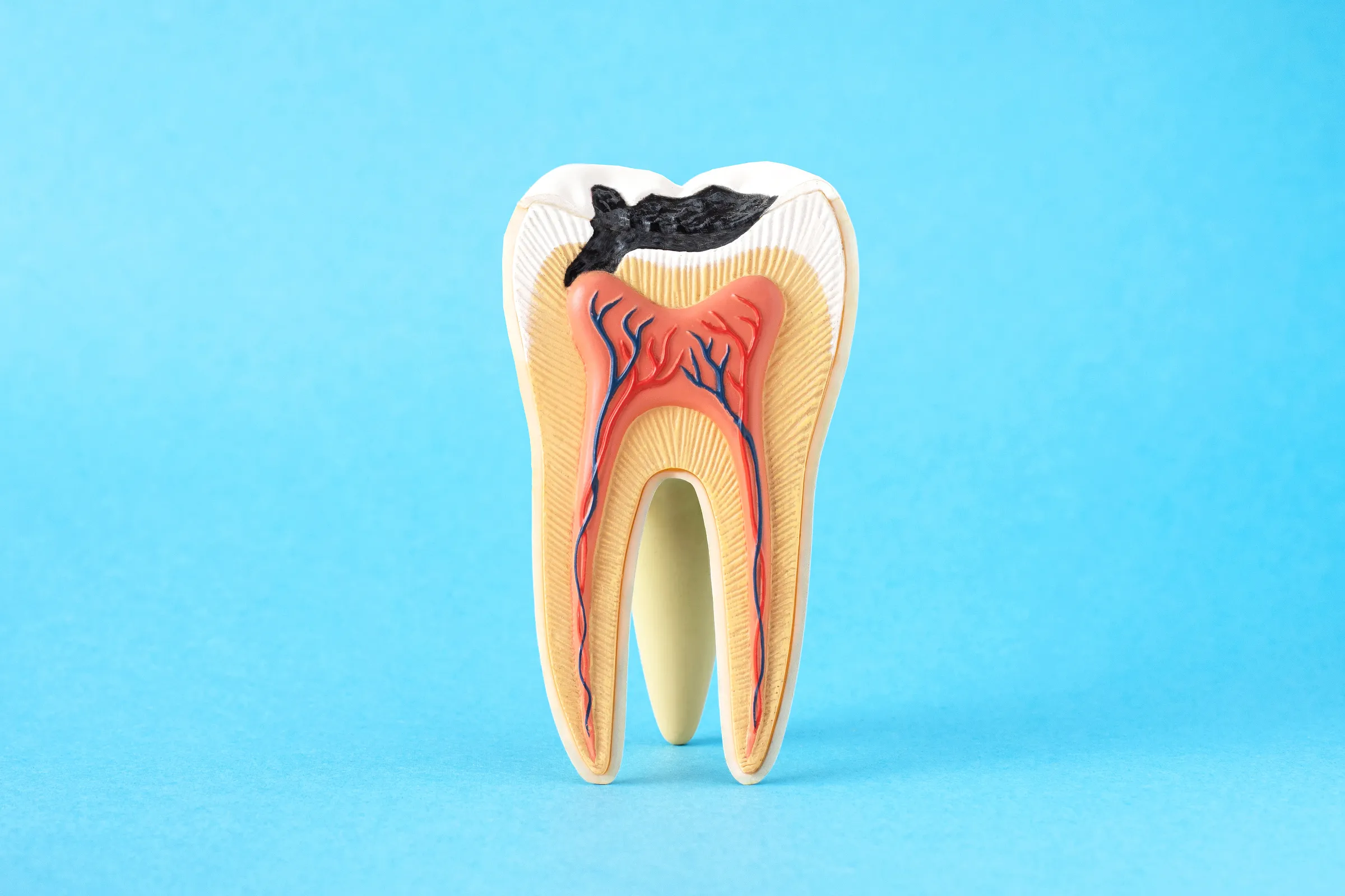 Cross-section illustration of a tooth with decay reaching the inner pulp