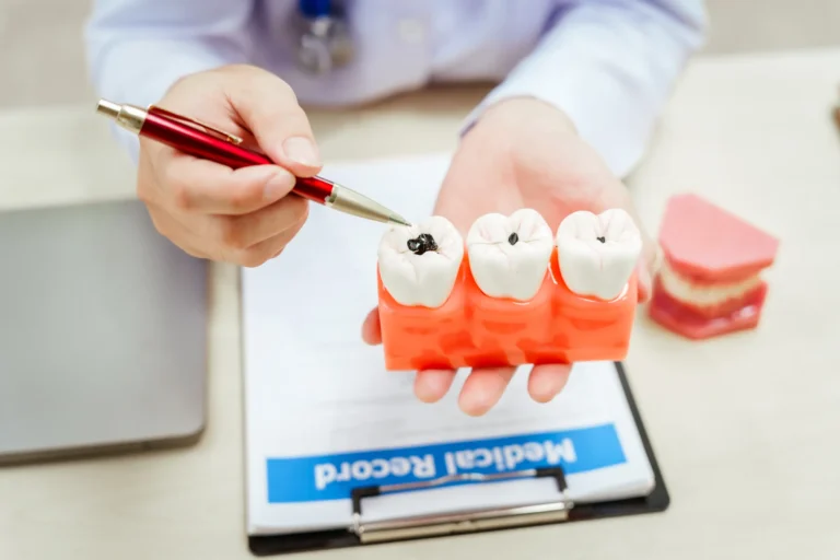 Dentist pointing a pen at cavities on a dental model beside a medical record