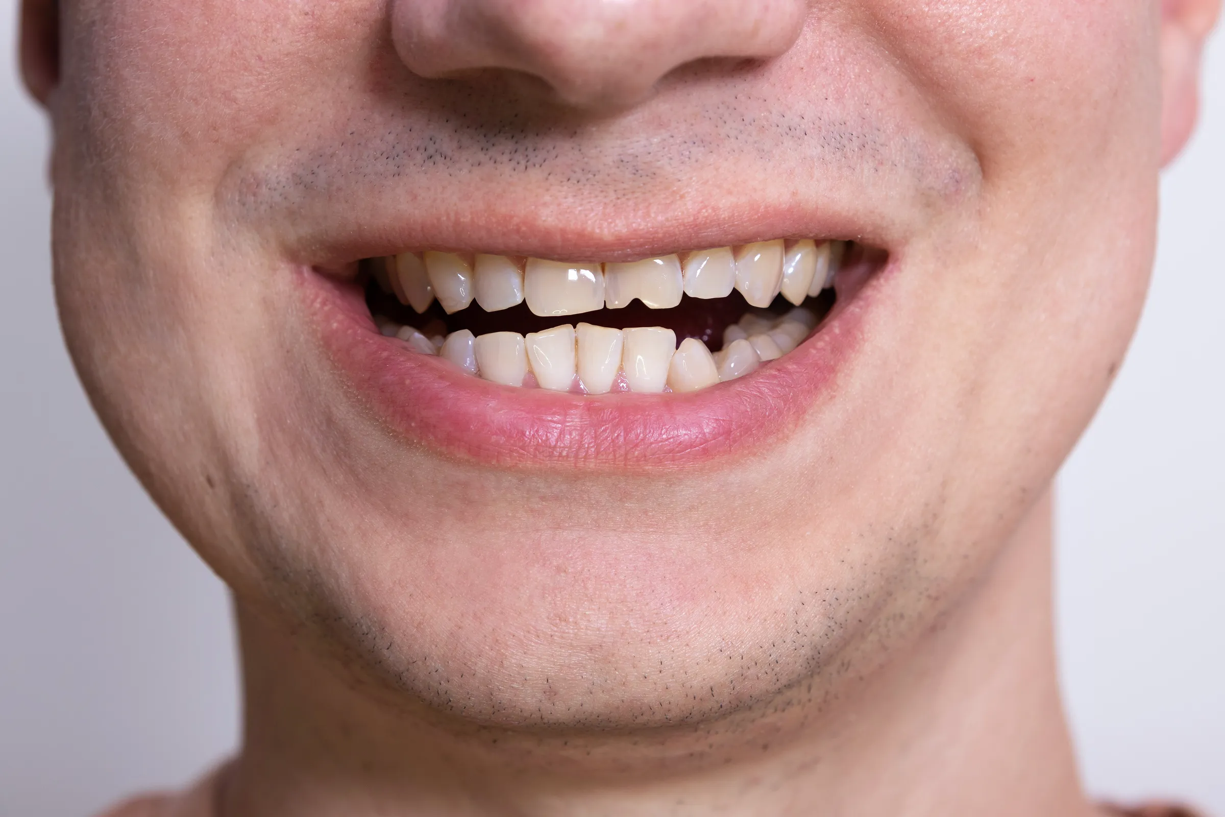 Close-up of a man's smile with a chipped front tooth