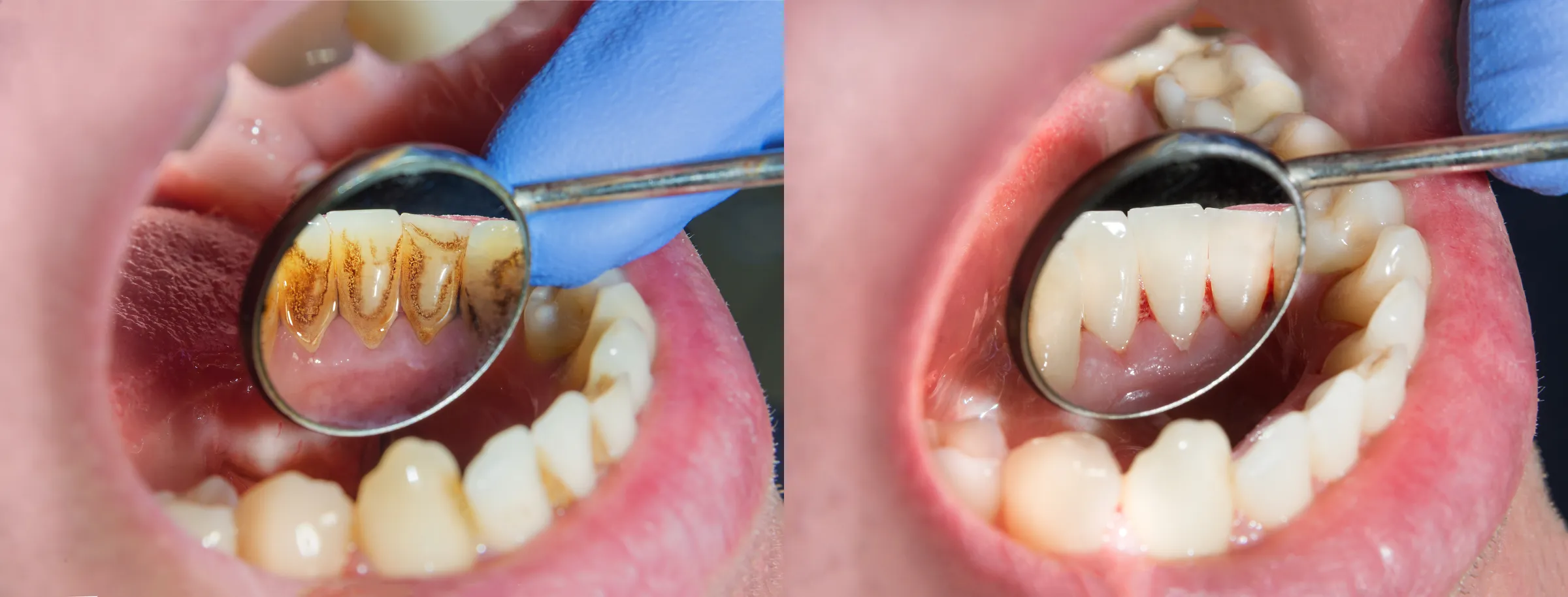 Mirror views of teeth before and after a professional cleaning
