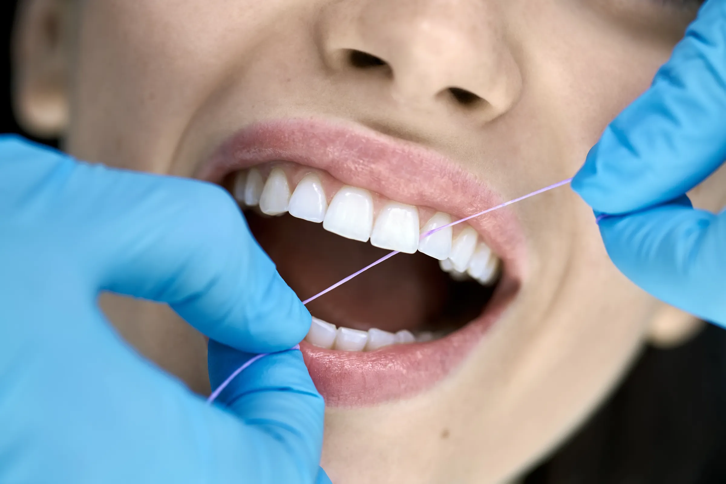 Gloved hands flossing a patient's teeth in close-up