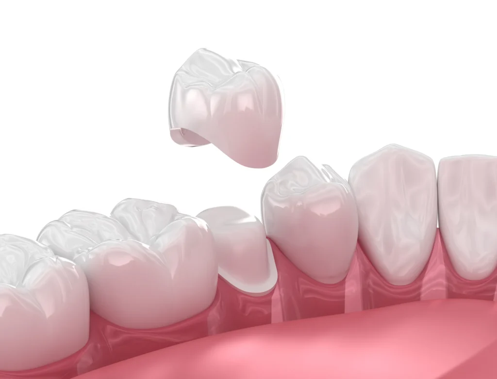 Illustration of a dental crown being placed over a prepared tooth