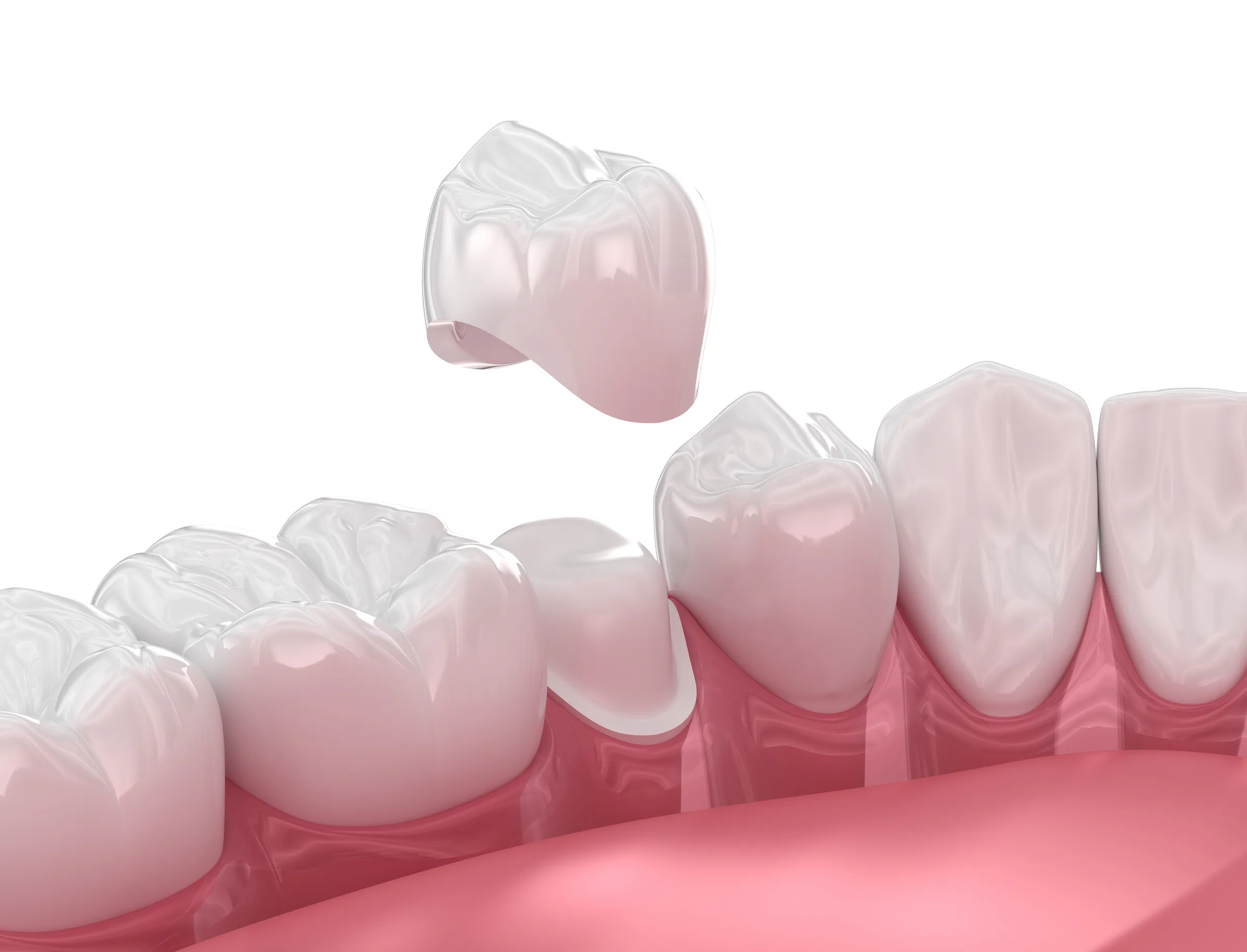 Illustration of a dental crown being placed over a prepared tooth