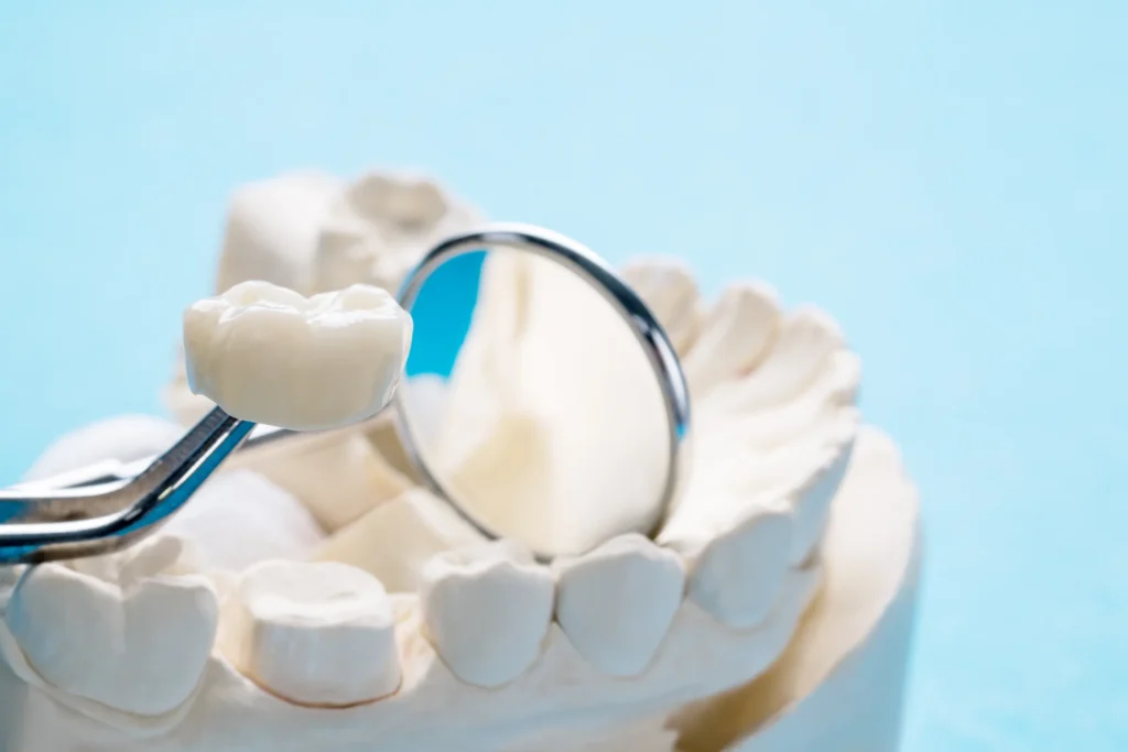 Dental crown on a model beside a dental mirror