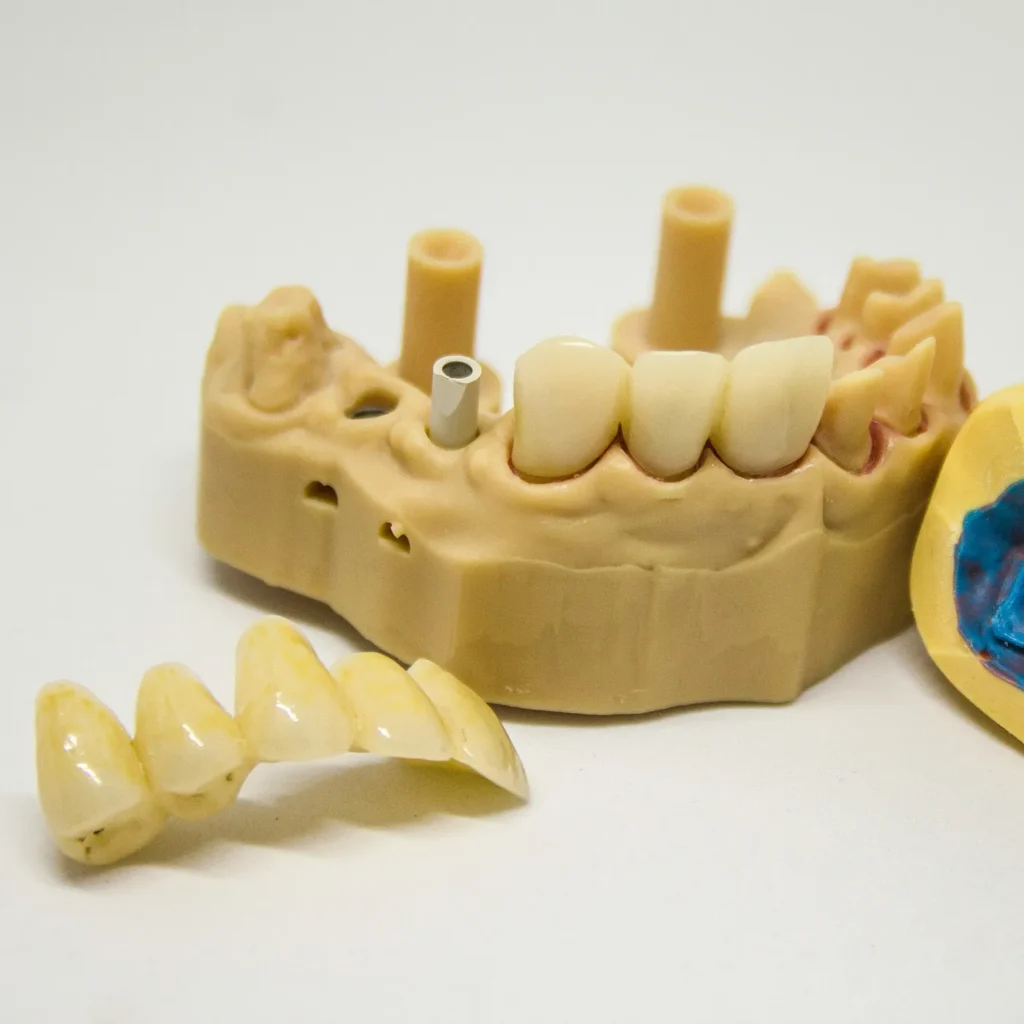 Dental bridge and crowns on a stone model