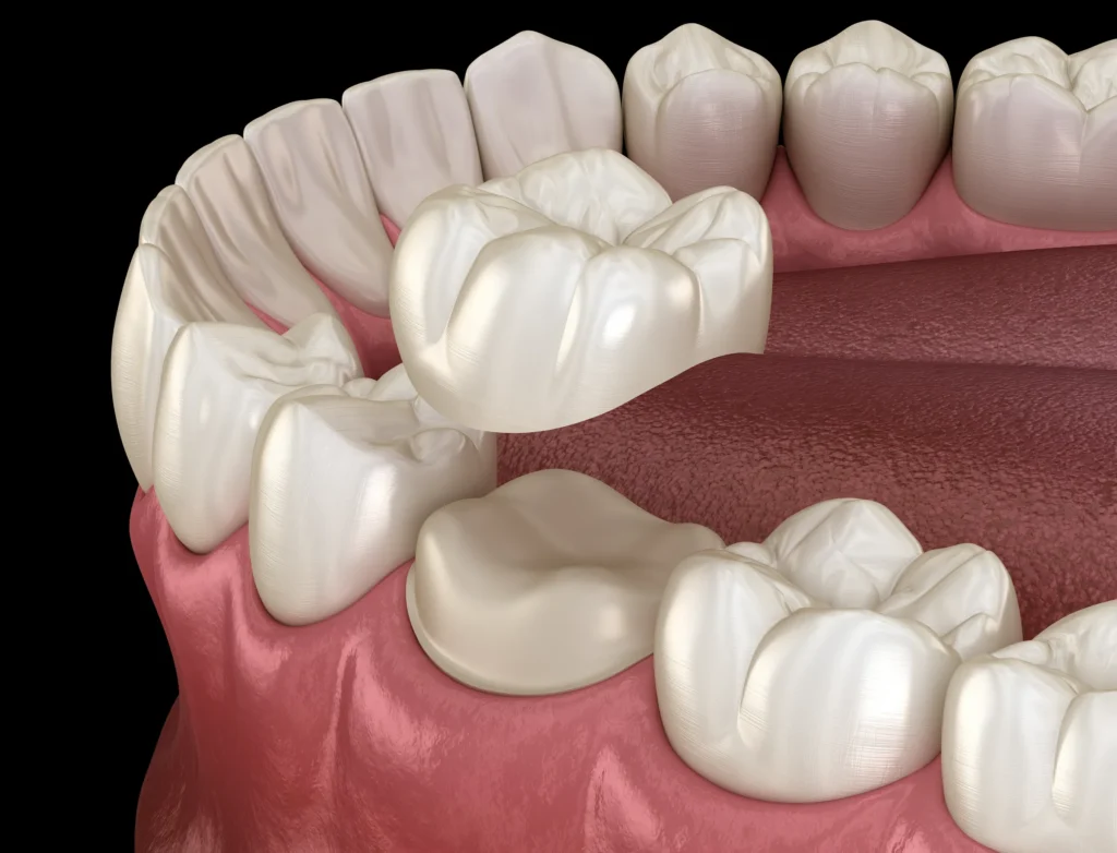 Illustration of a three-unit dental bridge being seated over prepared teeth