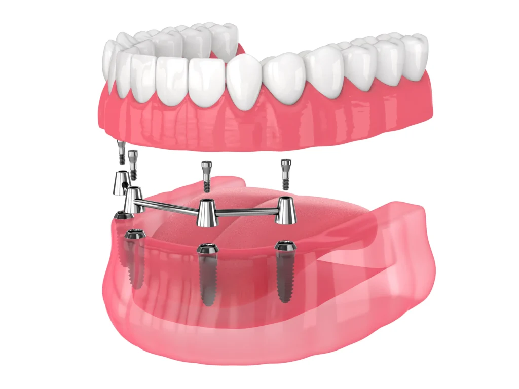 Illustration of an implant-supported overdenture above four implants
