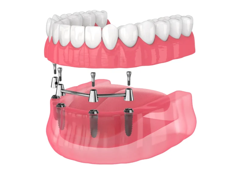 Illustration of an implant-supported overdenture above four implants
