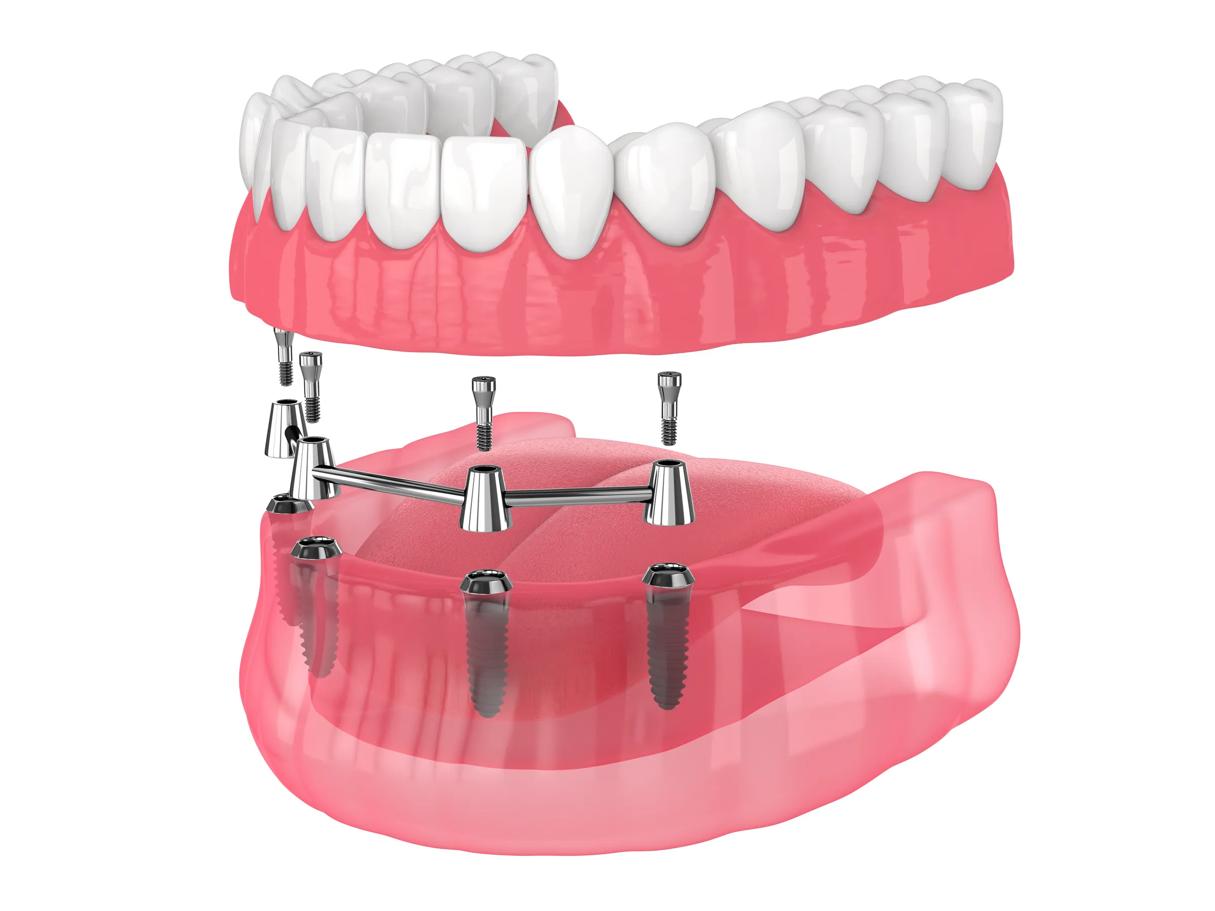 Illustration of an implant-supported overdenture above four implants