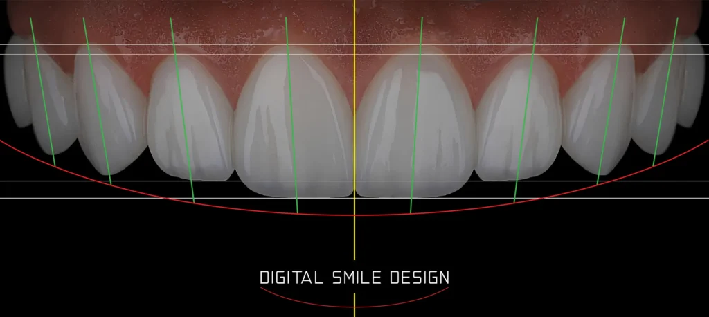 Digital smile design software analyzing tooth proportions