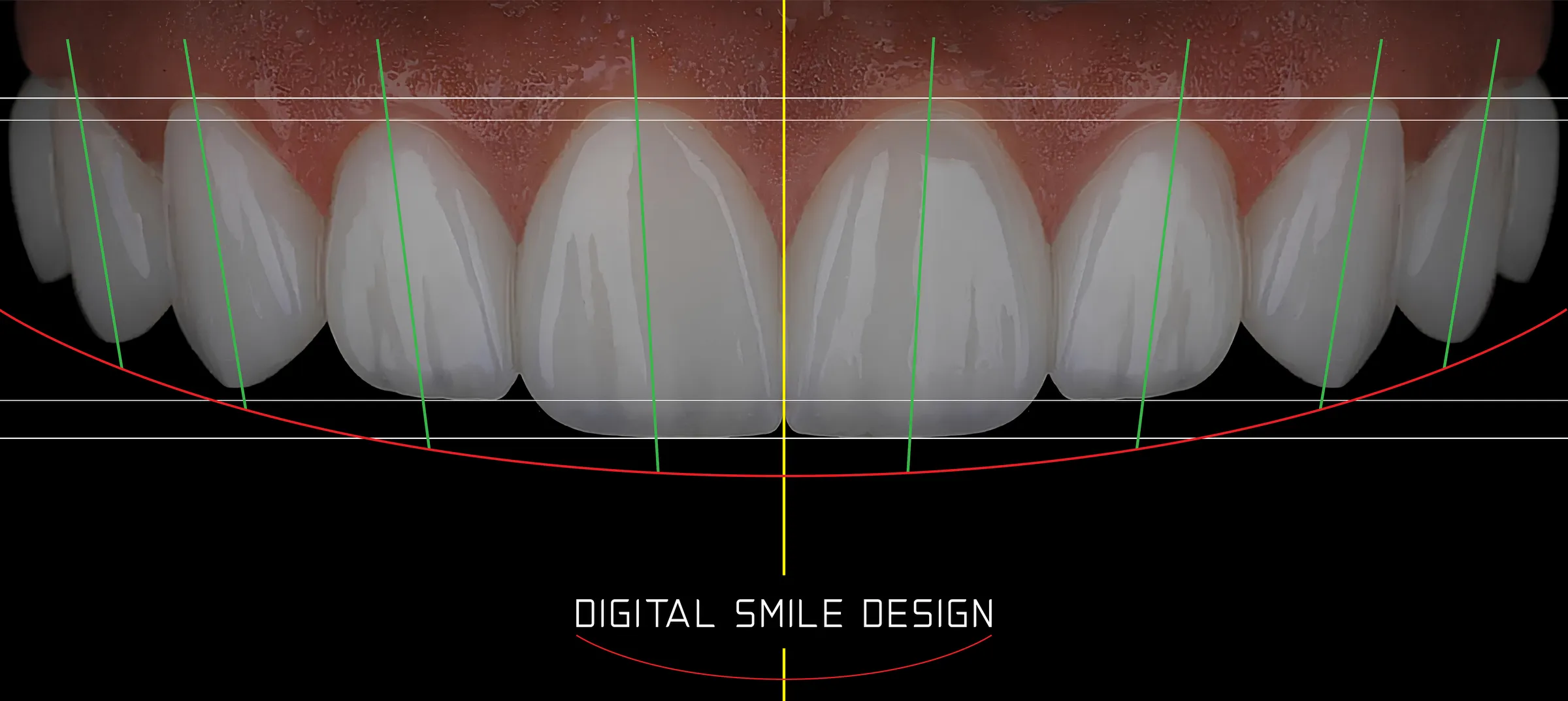 Digital smile design software analyzing tooth proportions