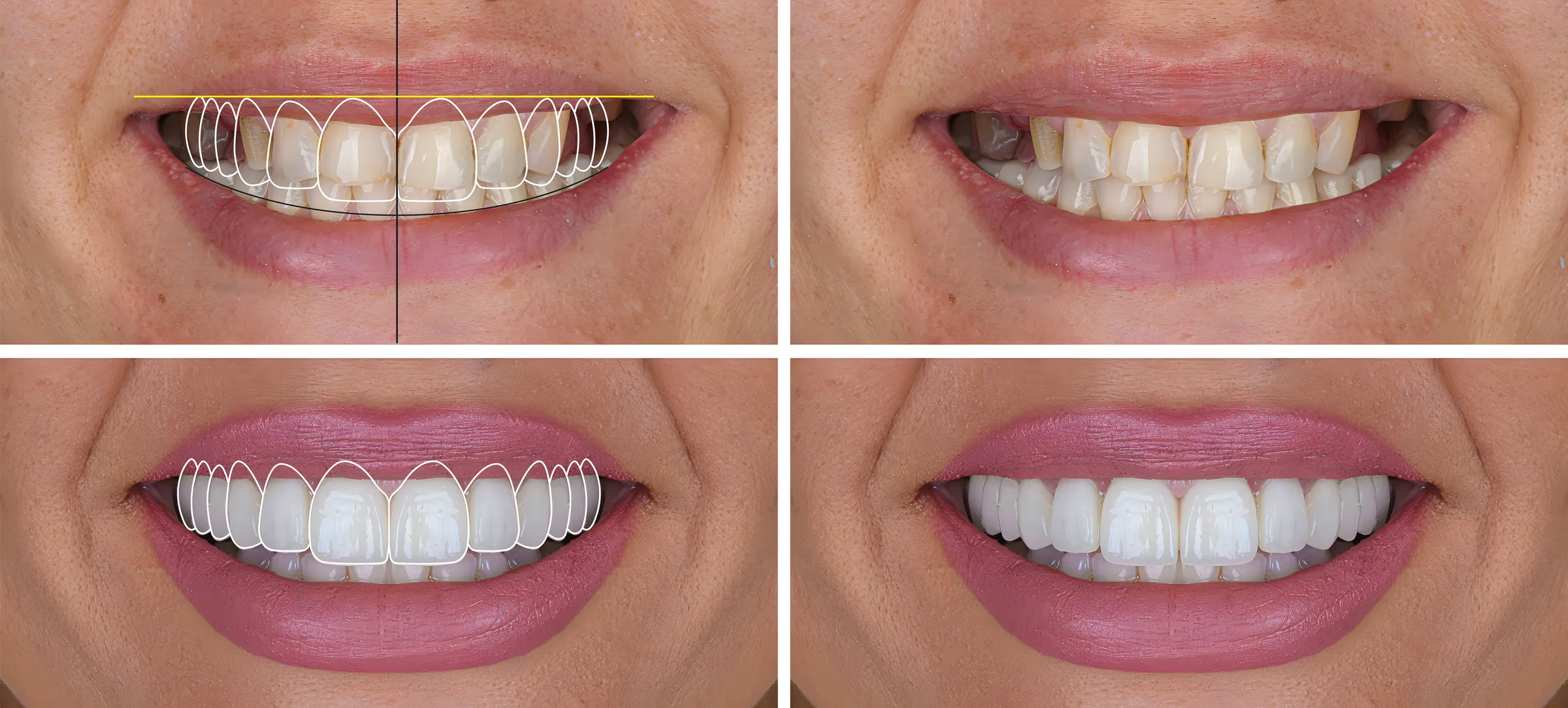 Four-panel digital smile design preview of a patient's smile