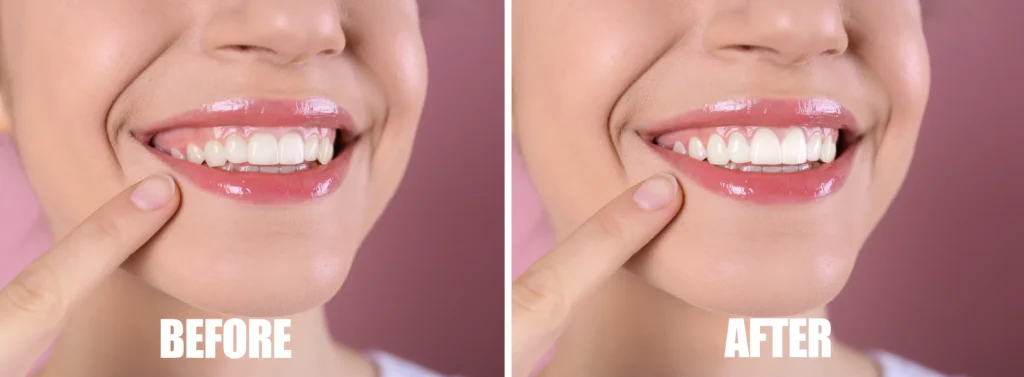 Before and after gum contouring showing a more even gum line