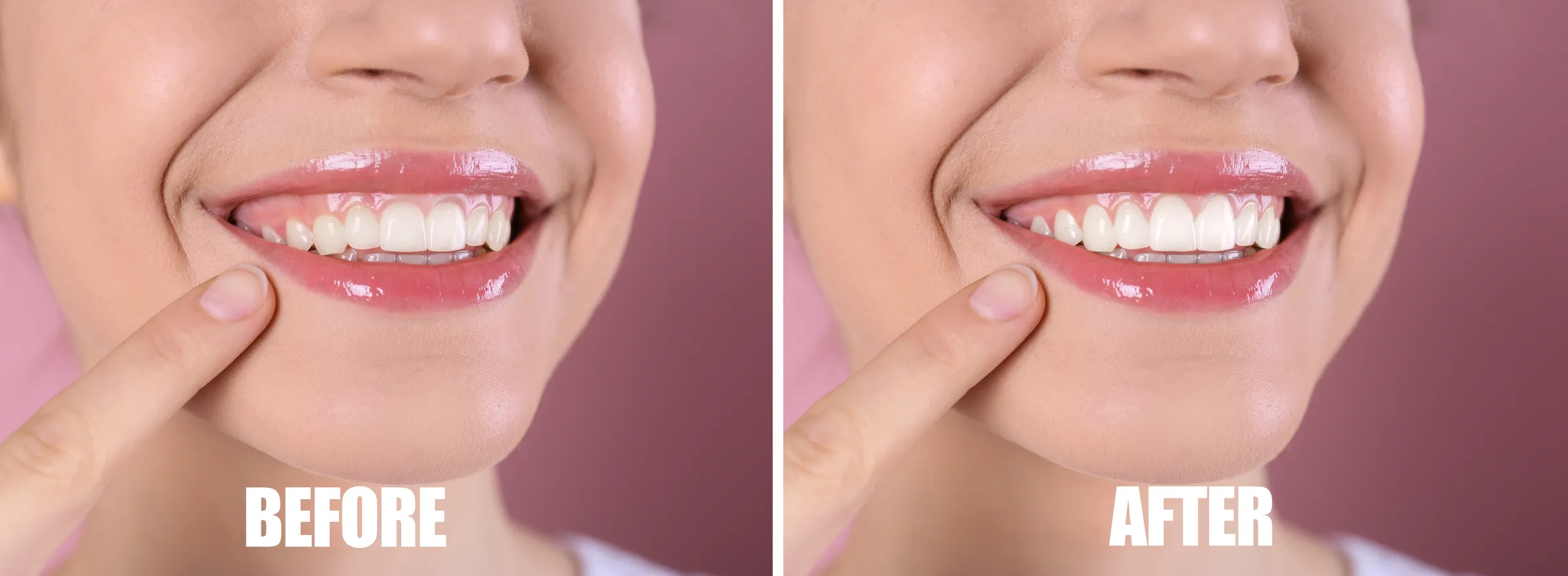 Before and after gum contouring showing a more even gum line