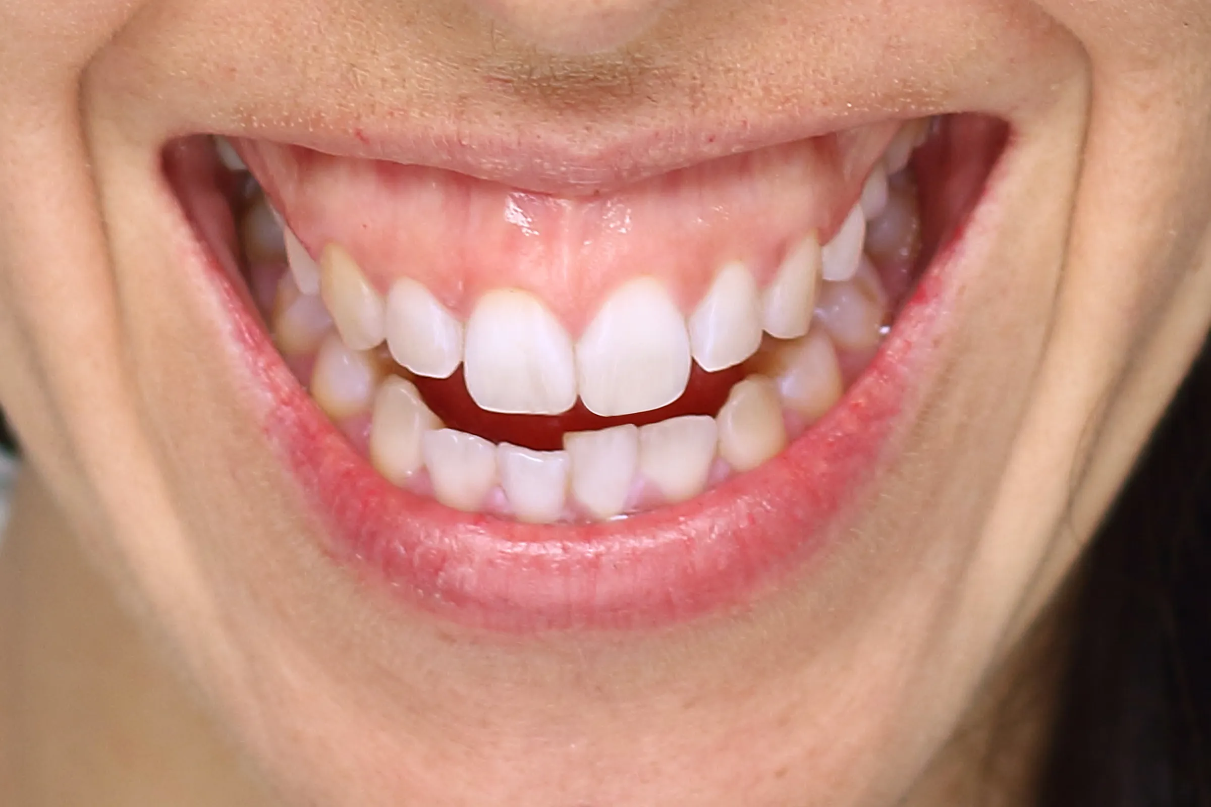 Close-up of a gummy smile