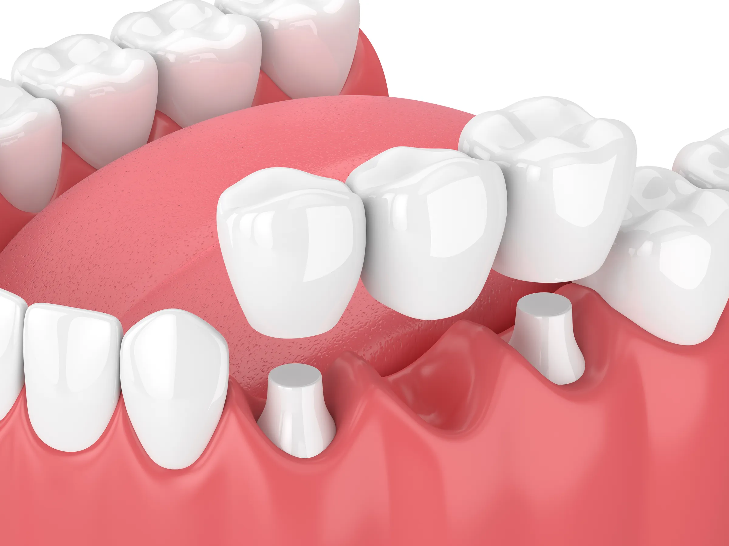 Illustration of a dental bridge being placed over a prepared tooth