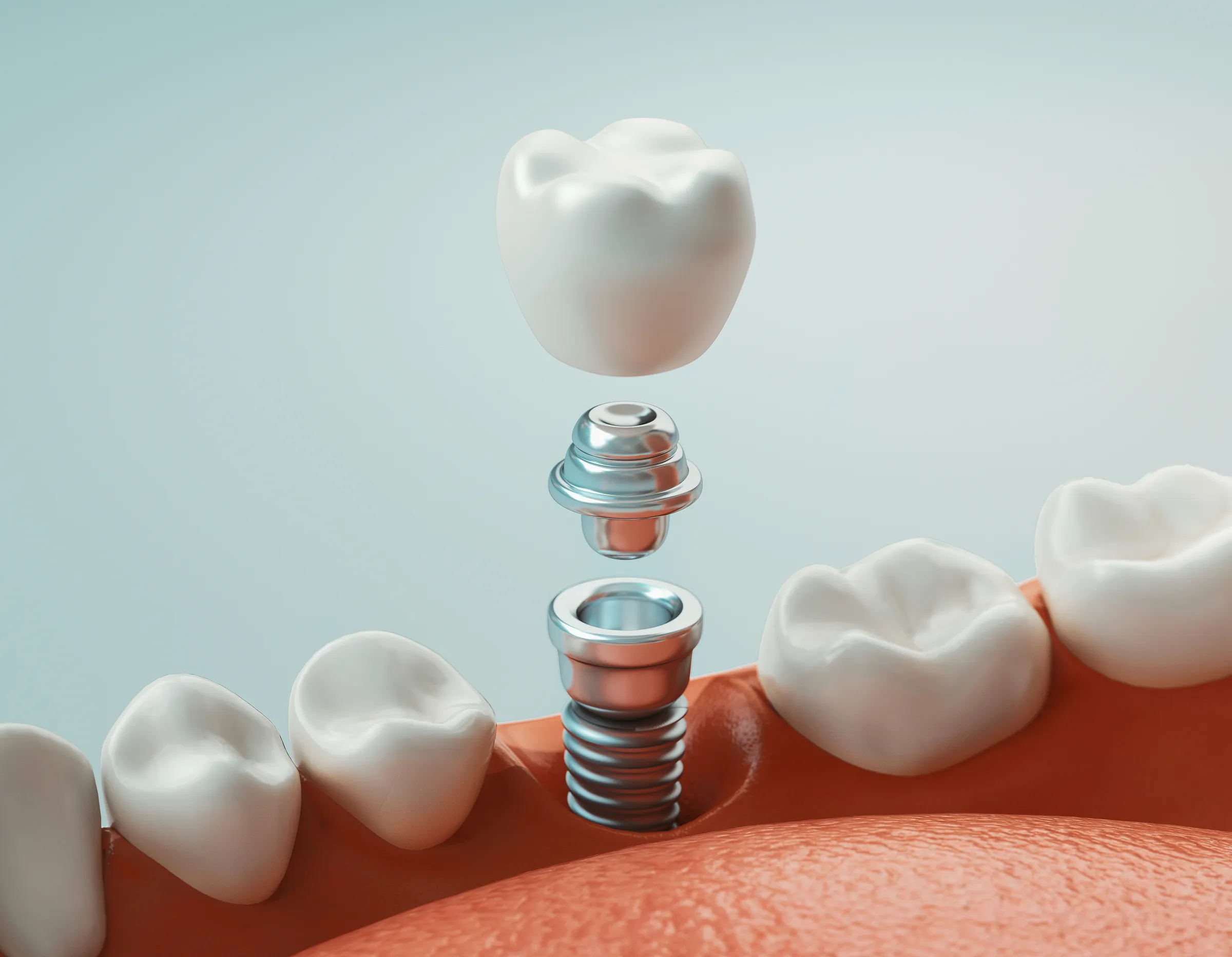 Illustration of a crown being fitted onto a dental implant