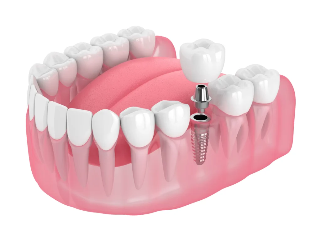 Illustration of a single dental implant and abutment in the lower jaw