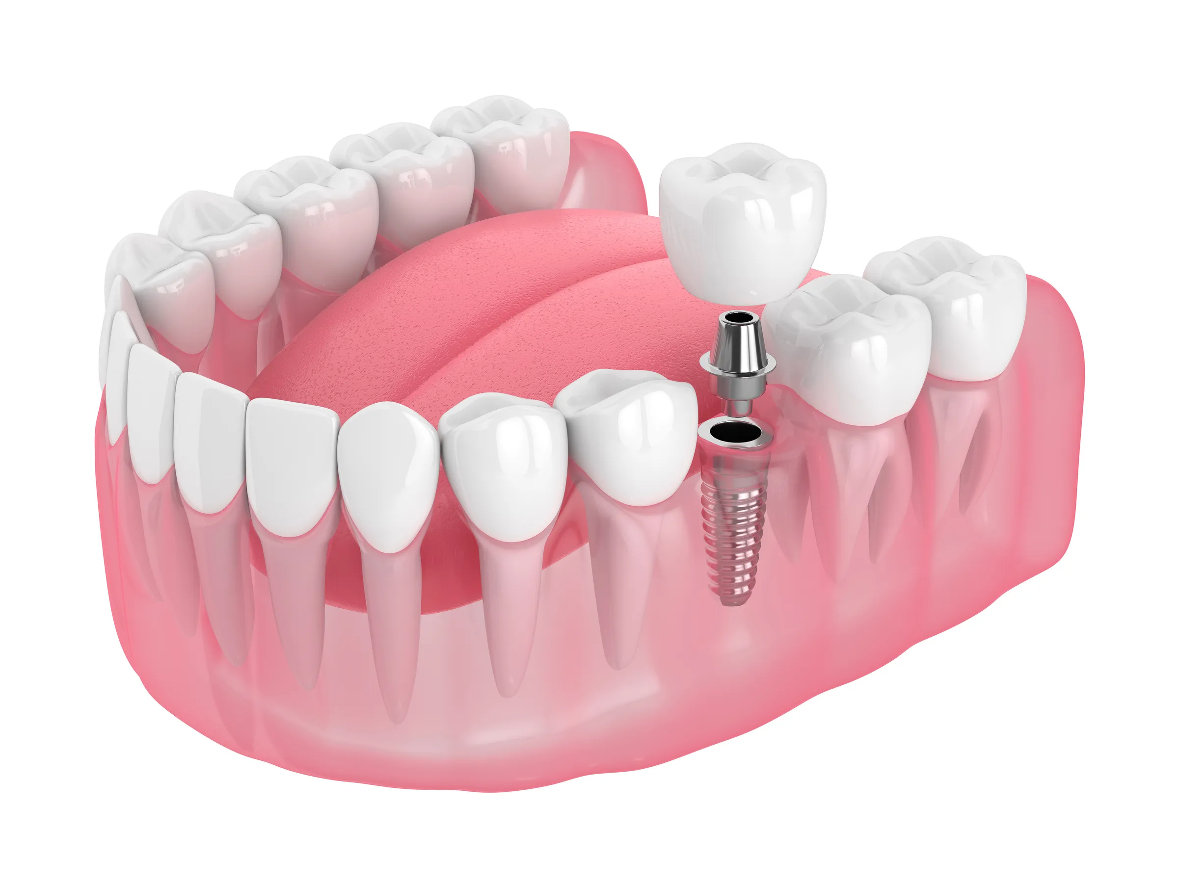 Illustration of a single dental implant and abutment in the lower jaw