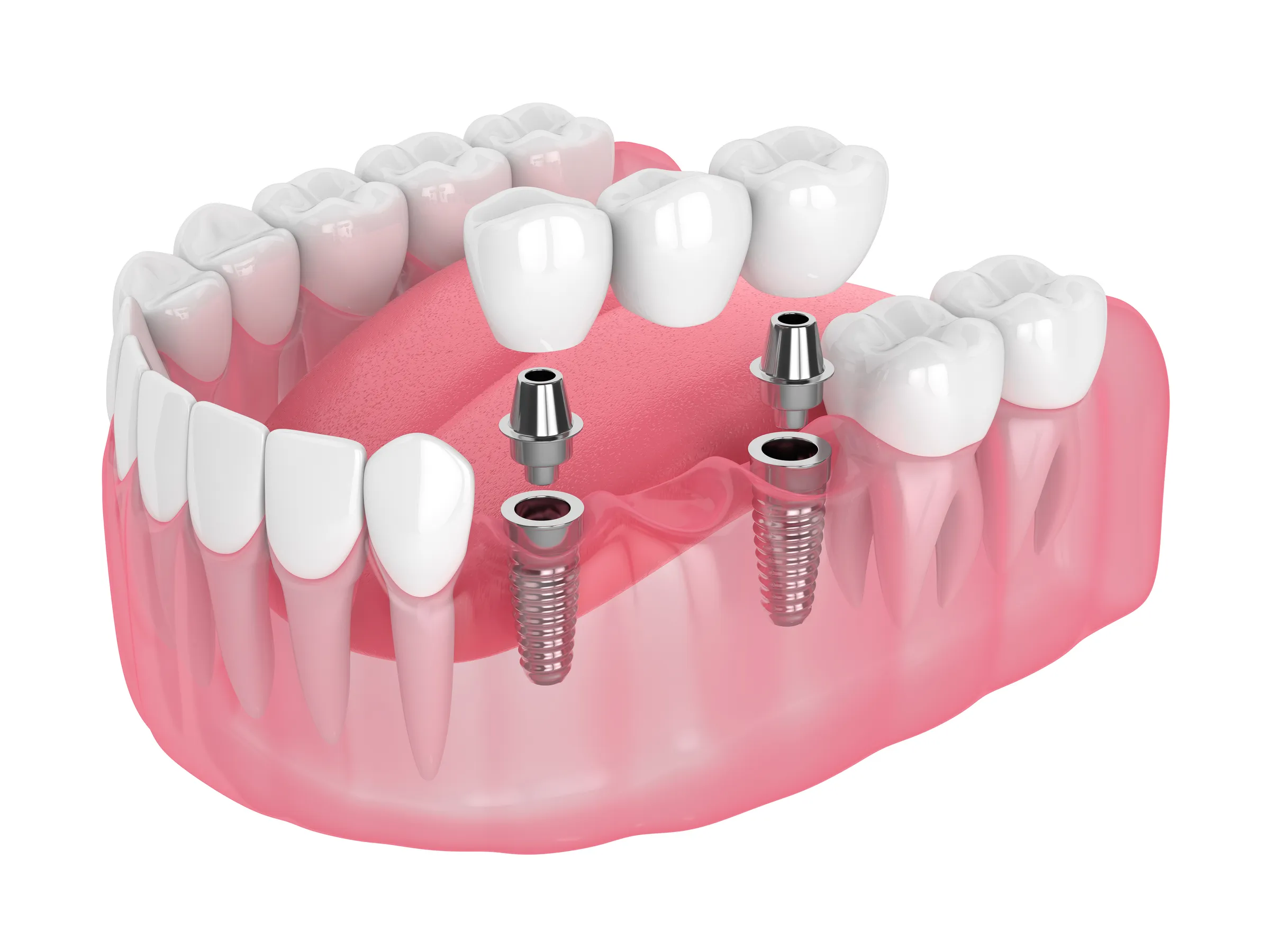 Illustration of two dental implants placed in the lower jaw