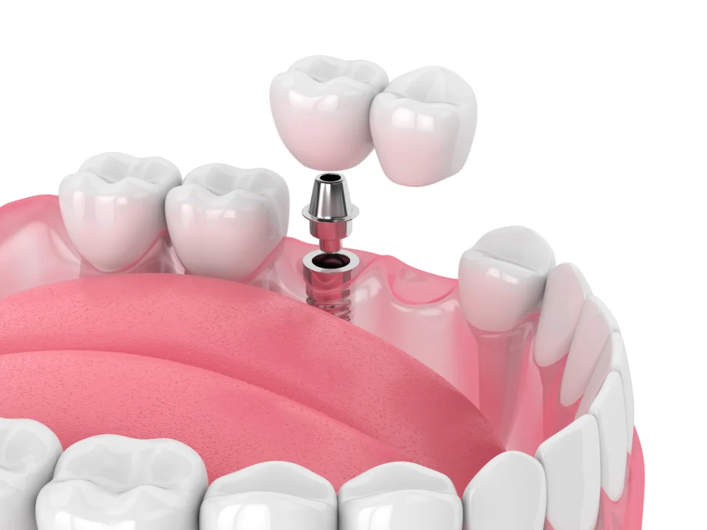 Illustration of an implant-supported bridge being seated
