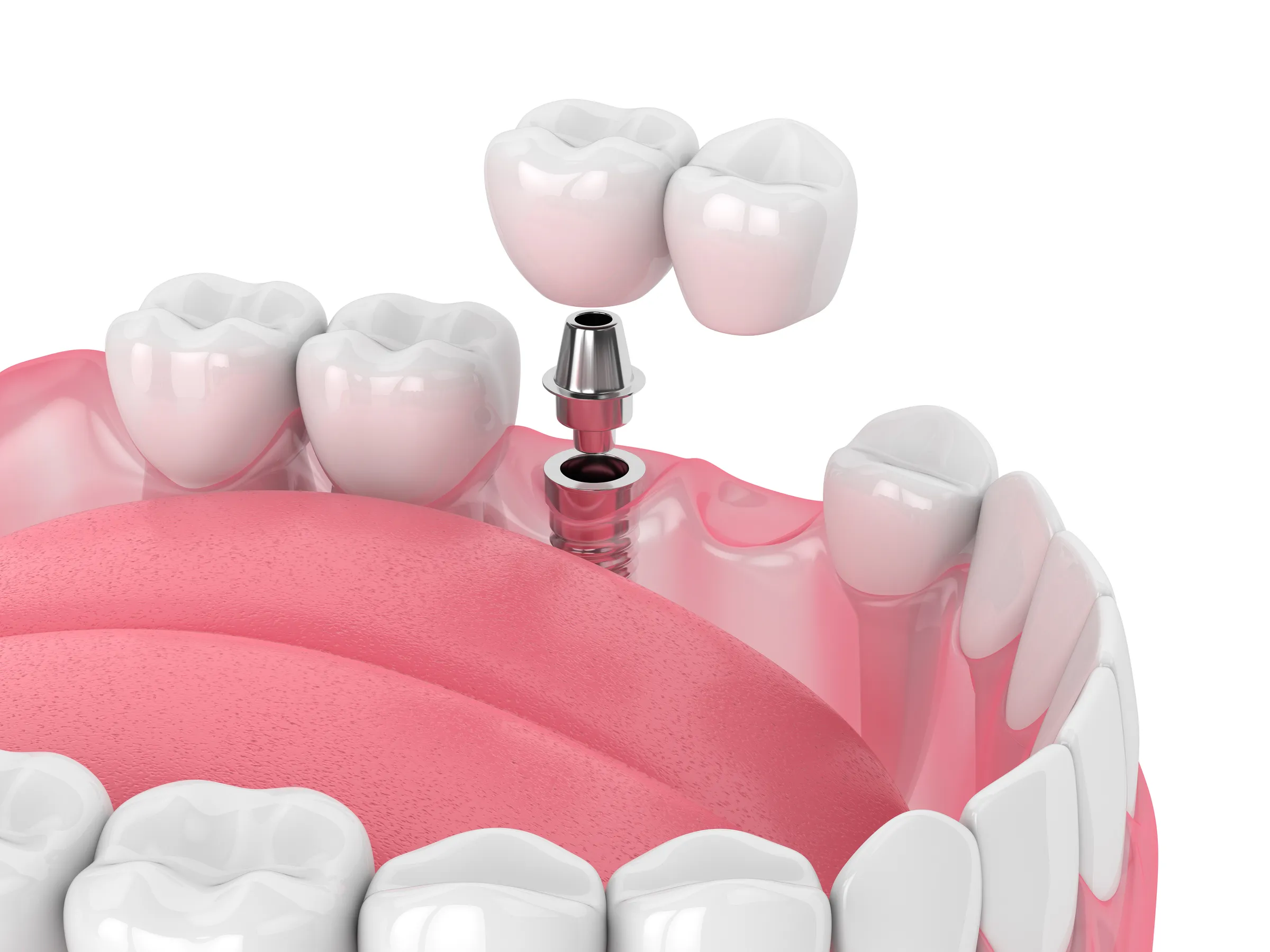 Illustration of an implant-supported bridge being seated