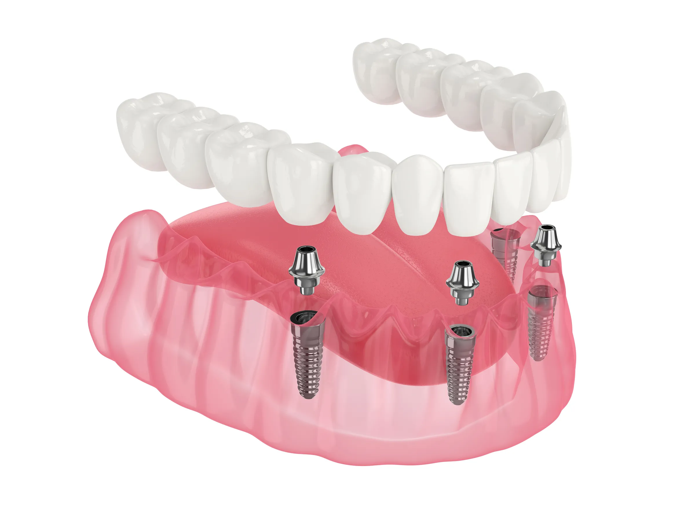 Illustration of an implant-supported denture above the lower jaw