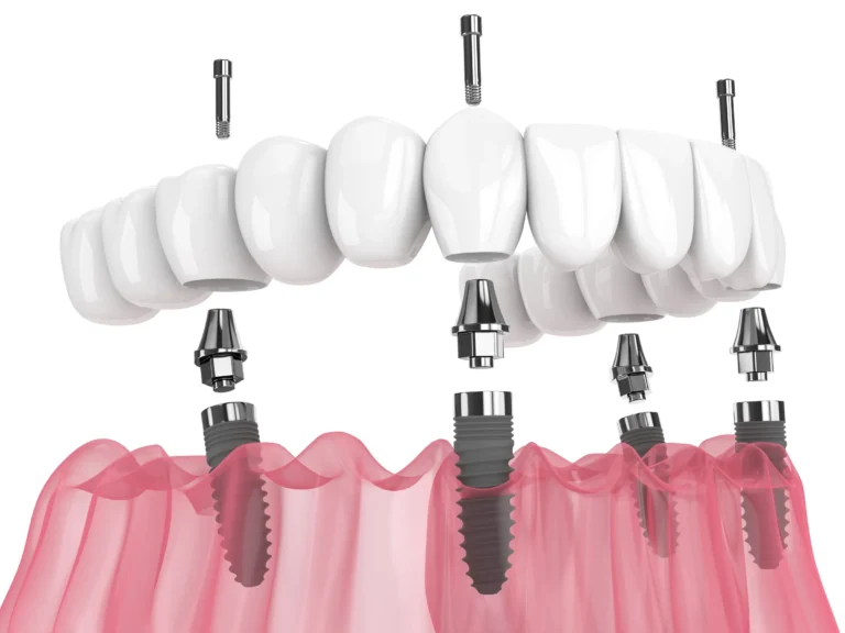 Illustration of a full-arch implant bridge above four implants