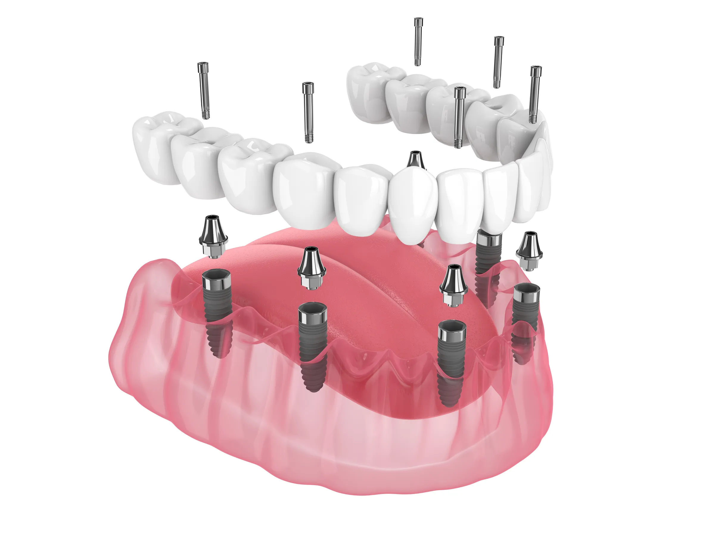 Illustration of an implant-supported full-arch restoration