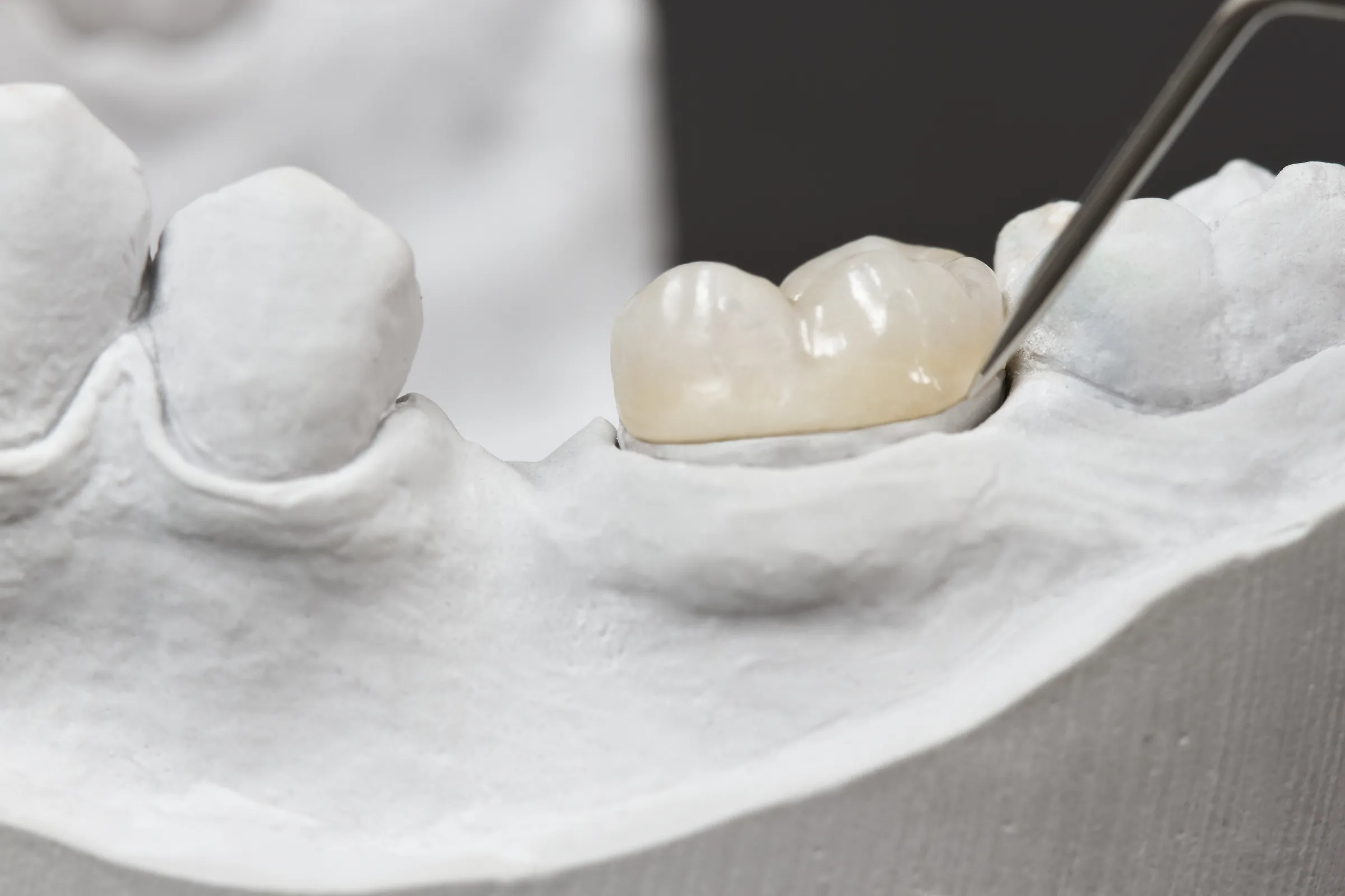 Inlay restoration seated on a plaster model