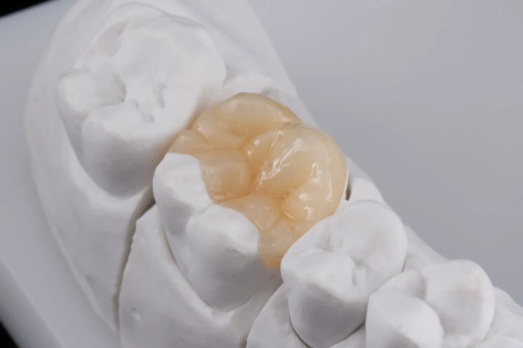 Close-up of an inlay restoration on a dental model