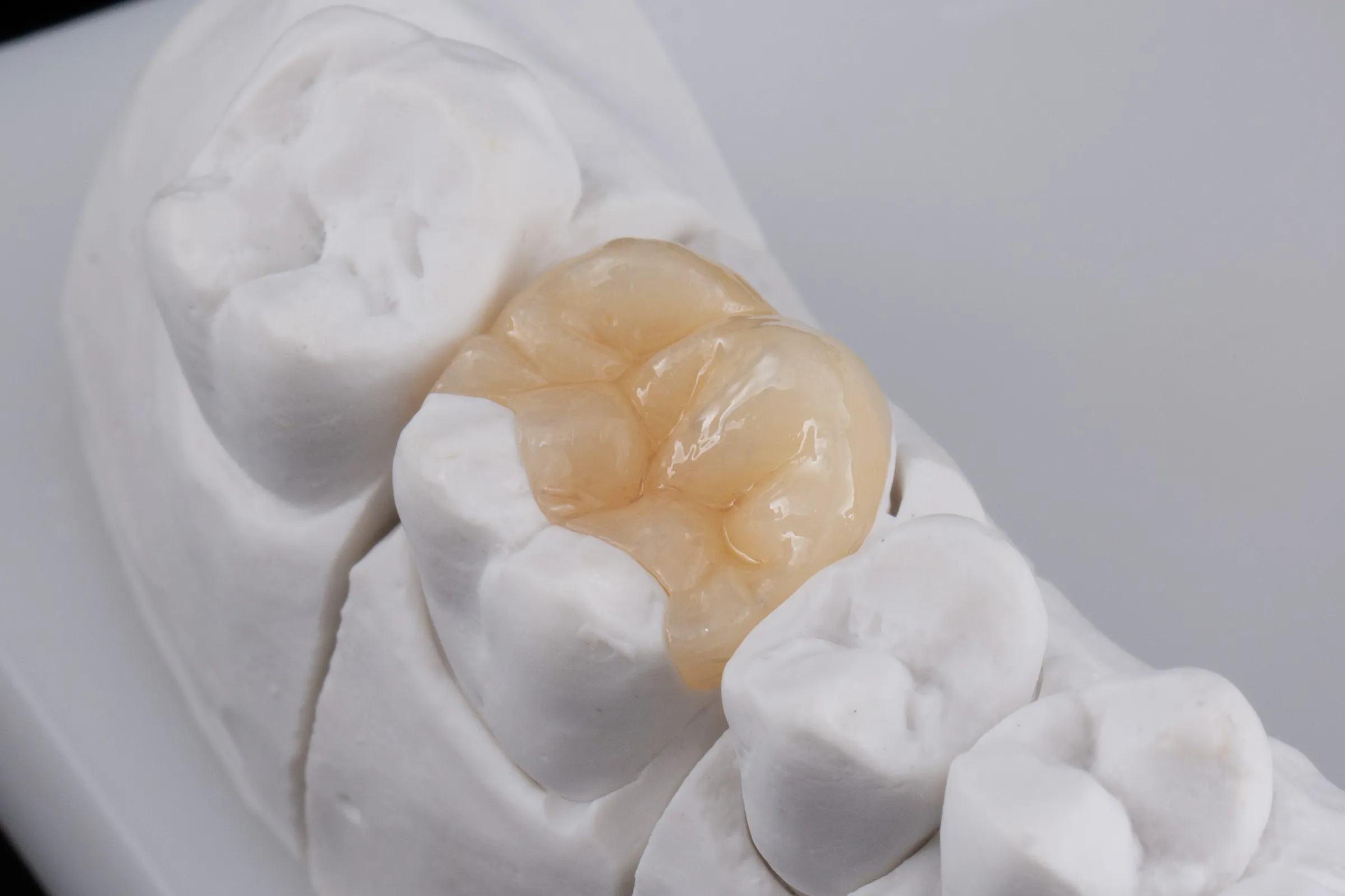 Tooth-colored inlay and onlay restorations