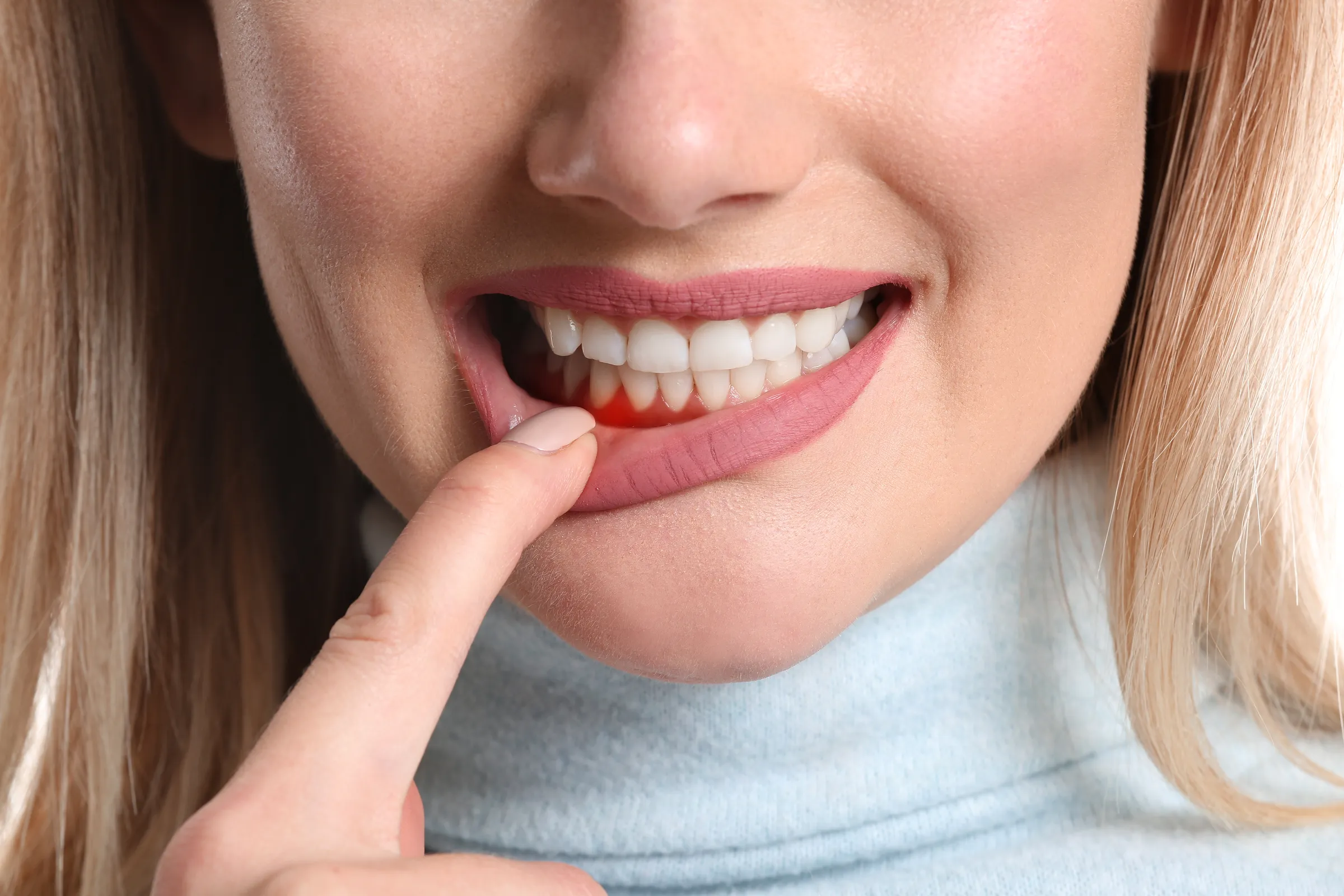 Woman pulling her lip down to show inflamed gums