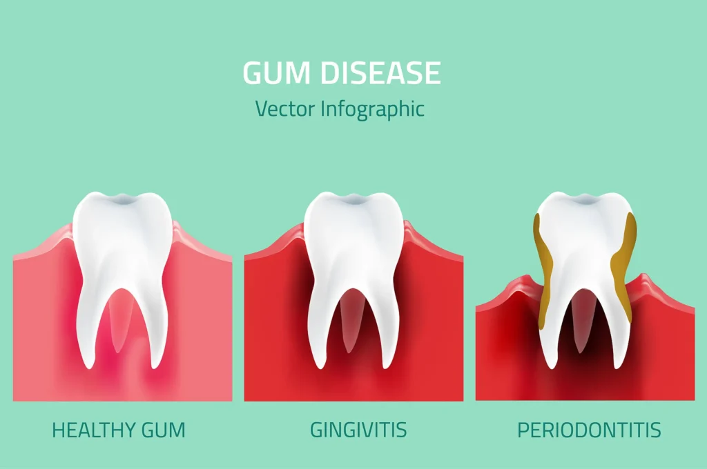 Infographic comparing healthy gums, gingivitis and periodontitis