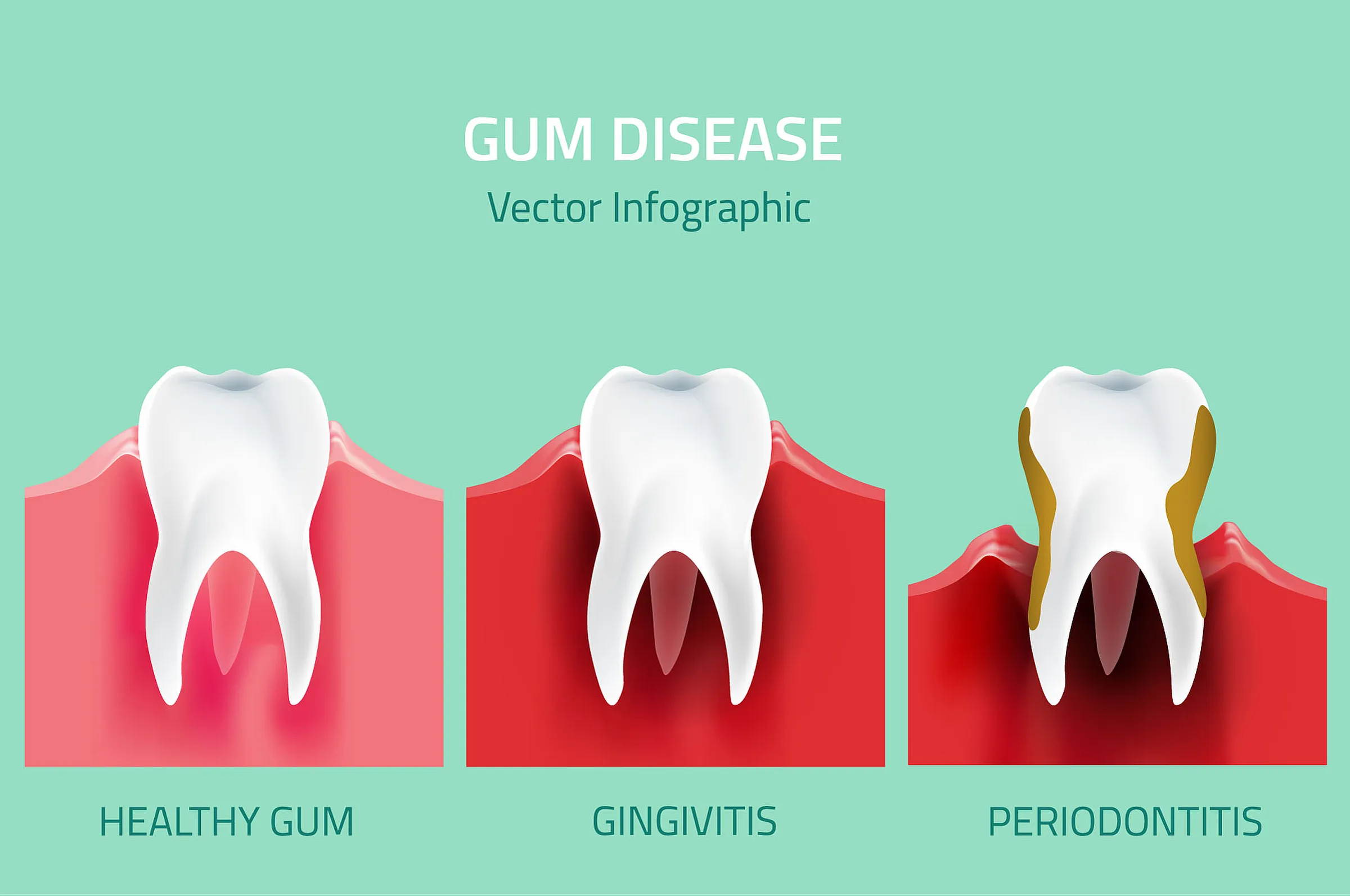 Infographic comparing healthy gums, gingivitis and periodontitis