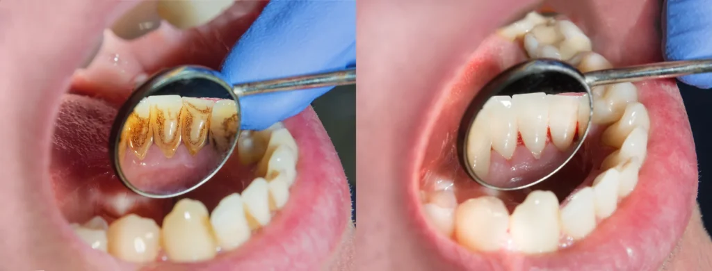 Mirror views of teeth before and after scaling and root planing