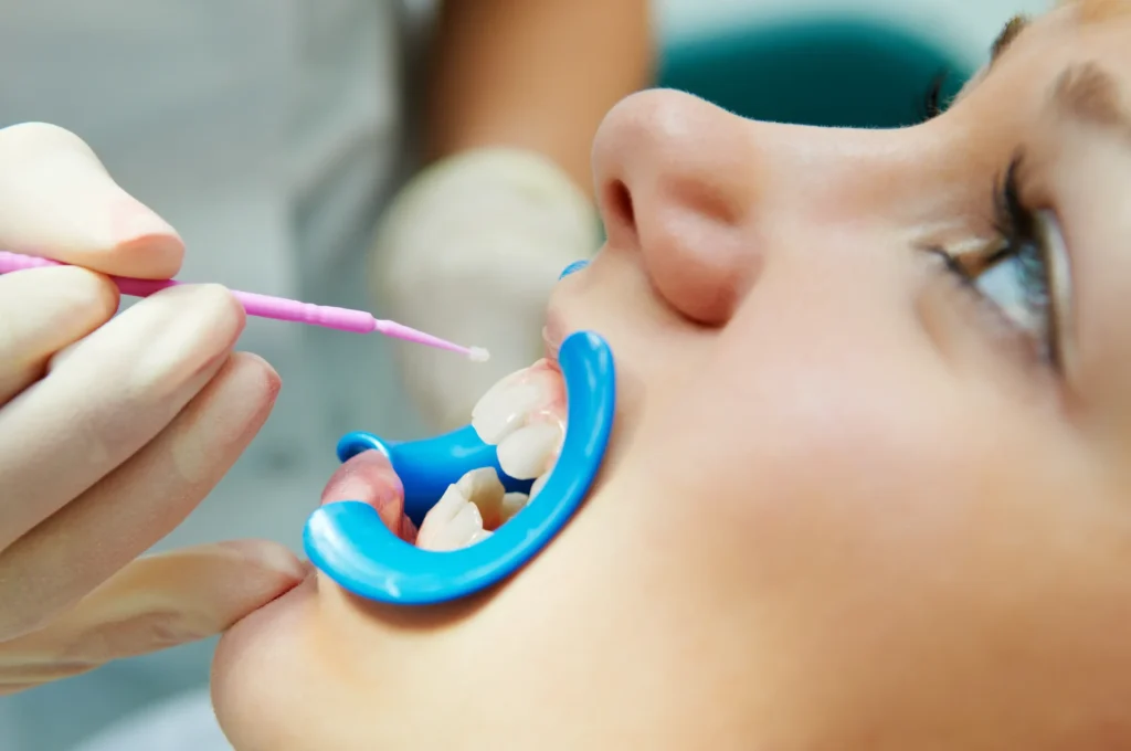 Patient having dental sealants applied