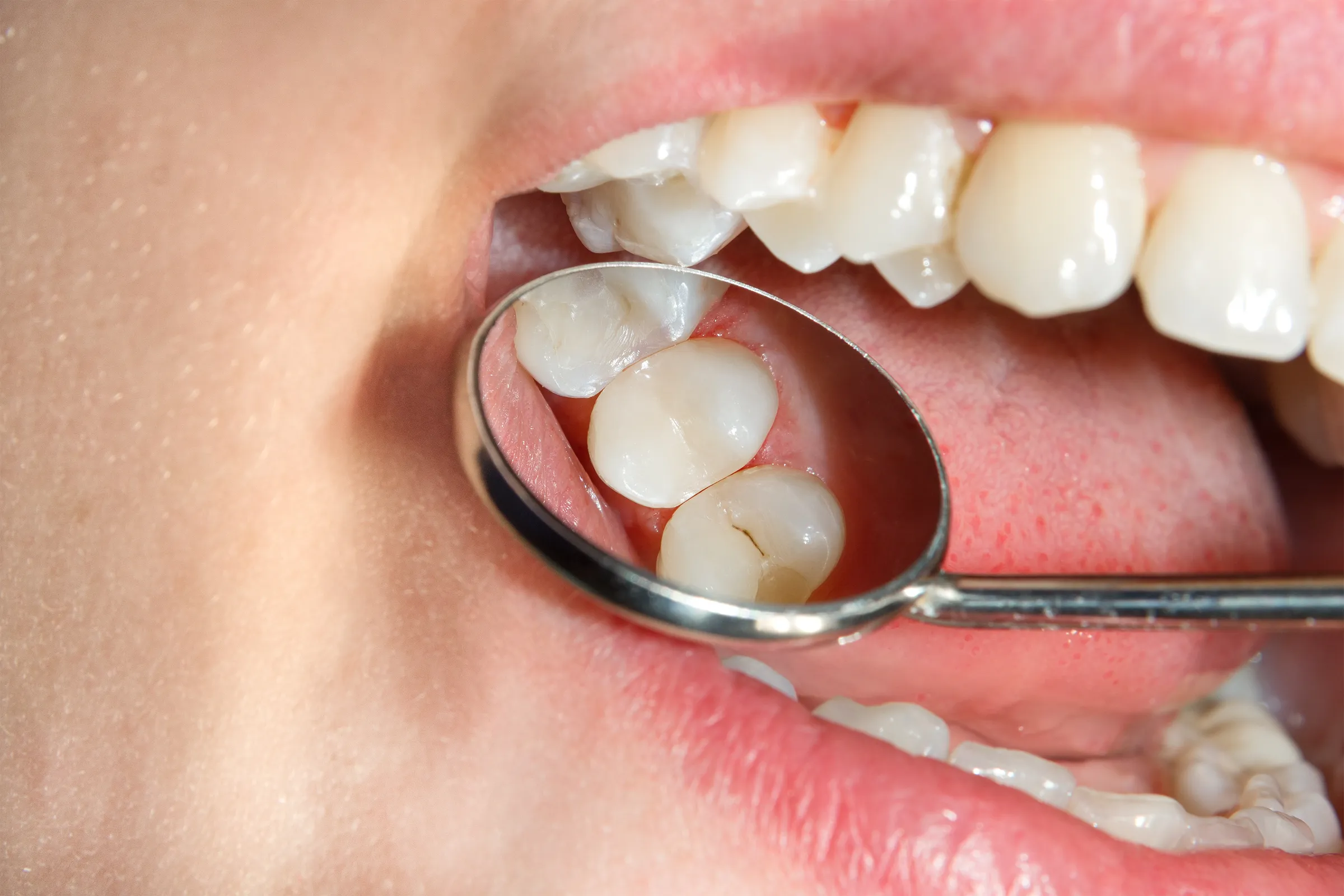 Mirror view of sealed molars