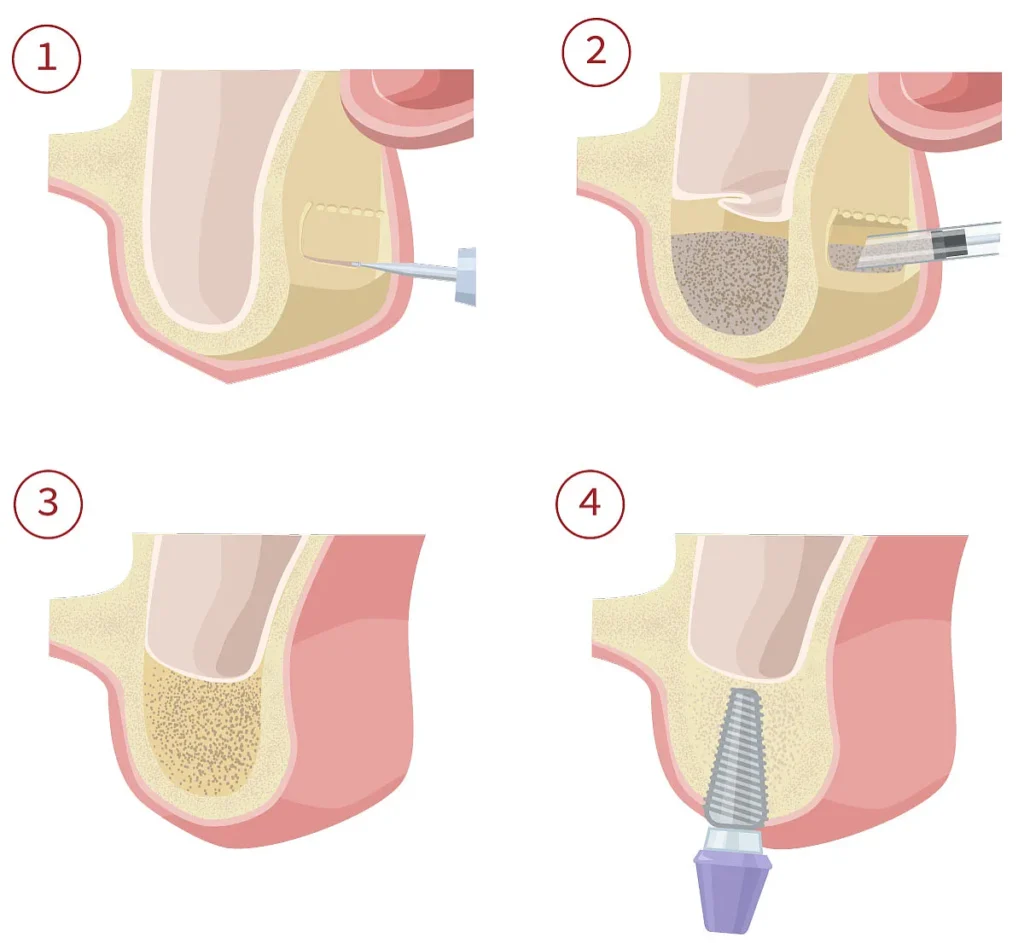 Four-stage illustration of a sinus lift and implant placement