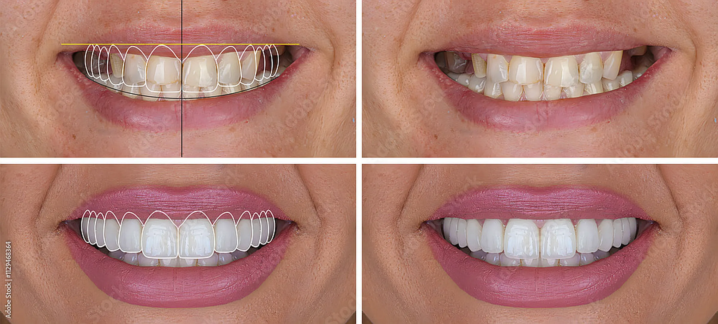Four-panel before and after smile makeover images