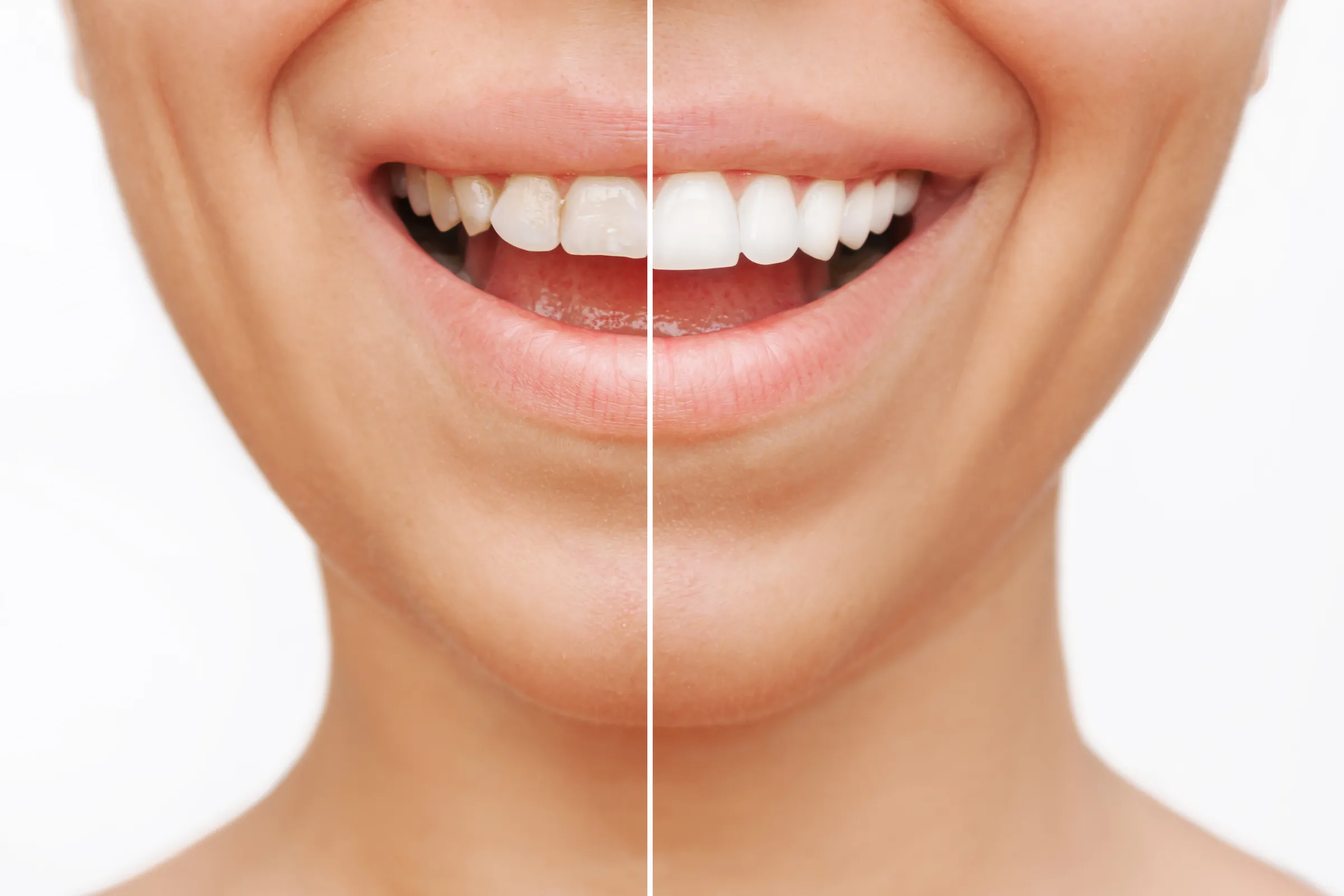 Split image of a smile before and after treatment