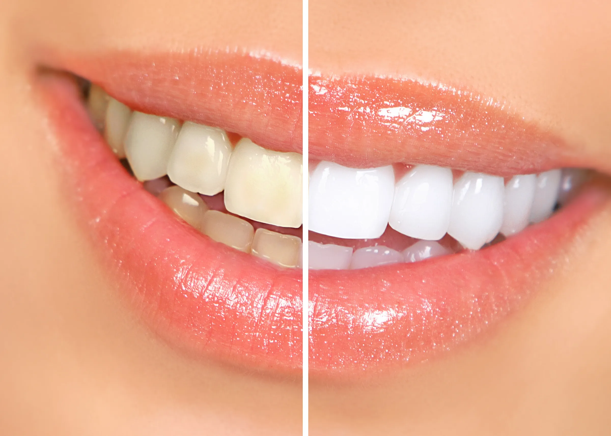Split image of a smile before and after whitening