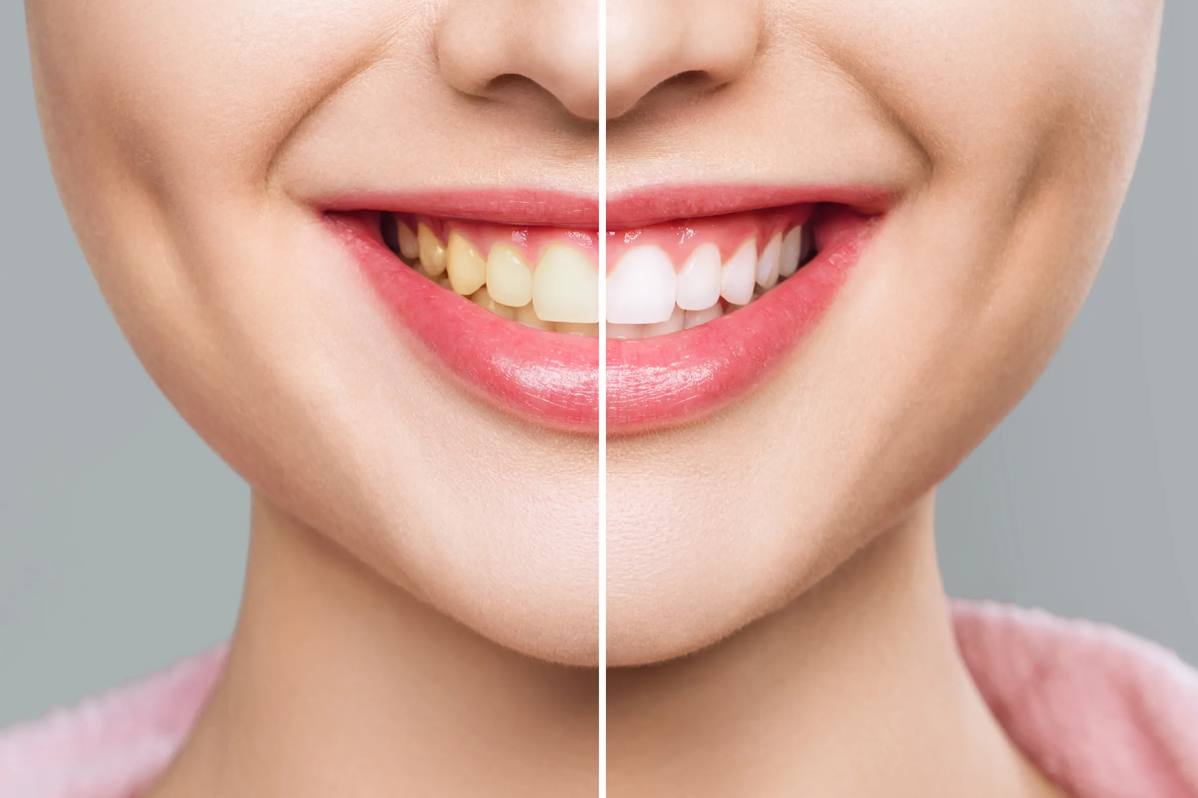 Split image of a smile before and after whitening
