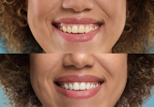 Before and after teeth whitening results